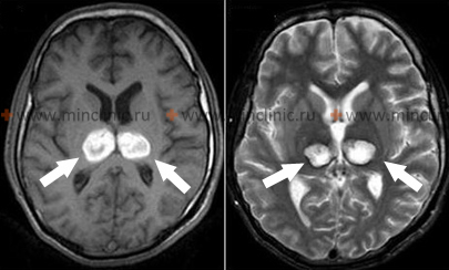 Brain MRI of a patient with intracerebral hemorrhage in the thalamus (arrows).